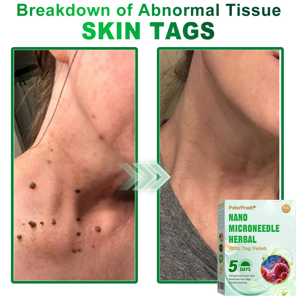 PolarFresh® Nano Microneedle Herbal Skin Tag Patch