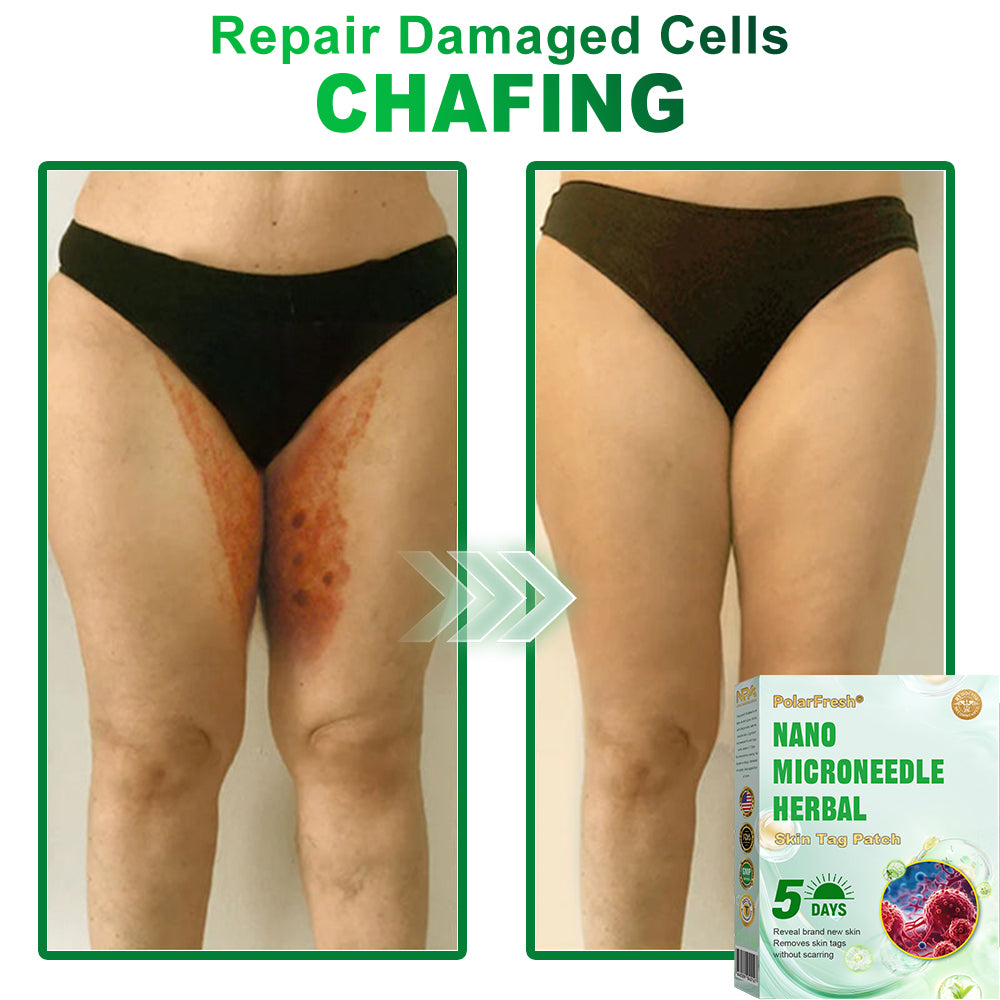 PolarFresh® Nano Microneedle Herbal Skin Tag Patch