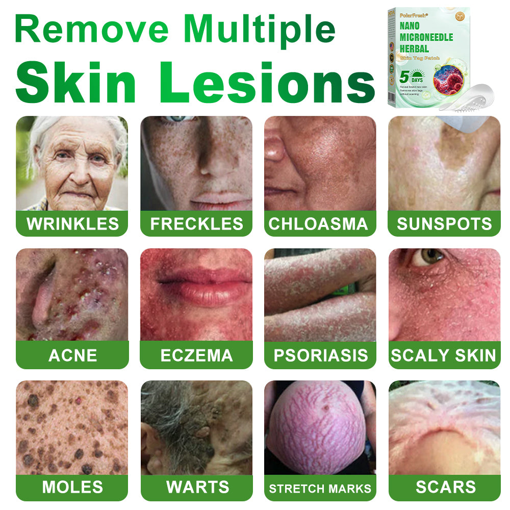 PolarFresh® Nano Microneedle Herbal Skin Tag Patch