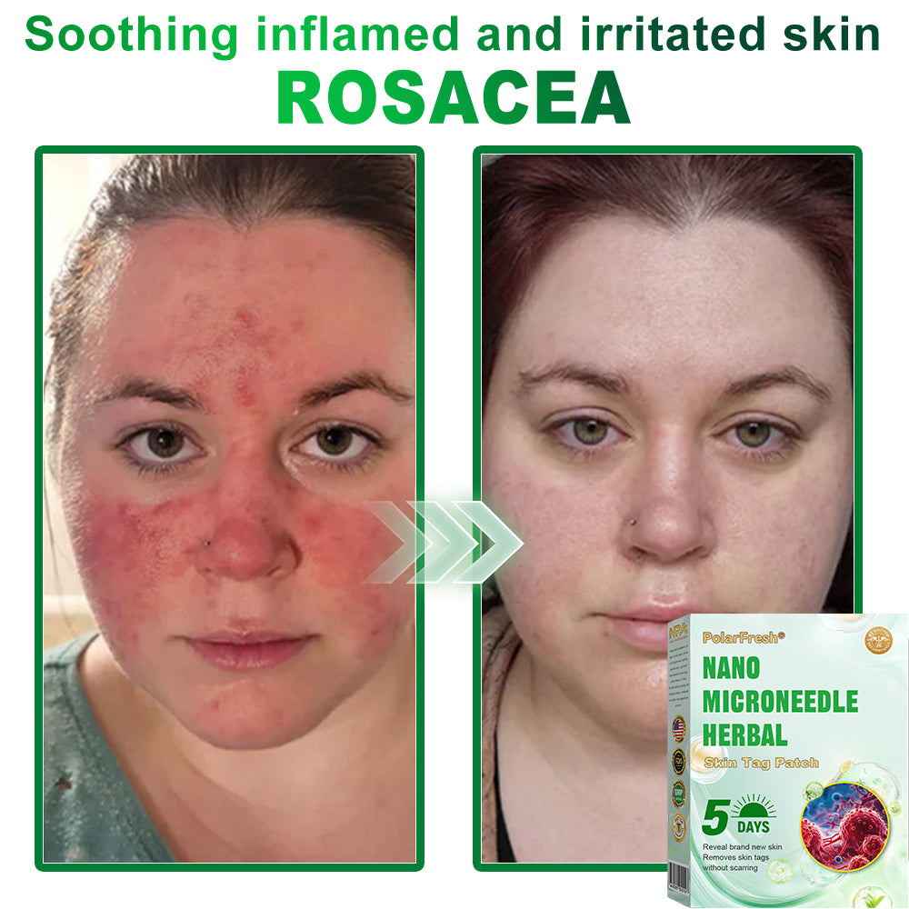 PolarFresh® Nano Microneedle Herbal Skin Tag Patch
