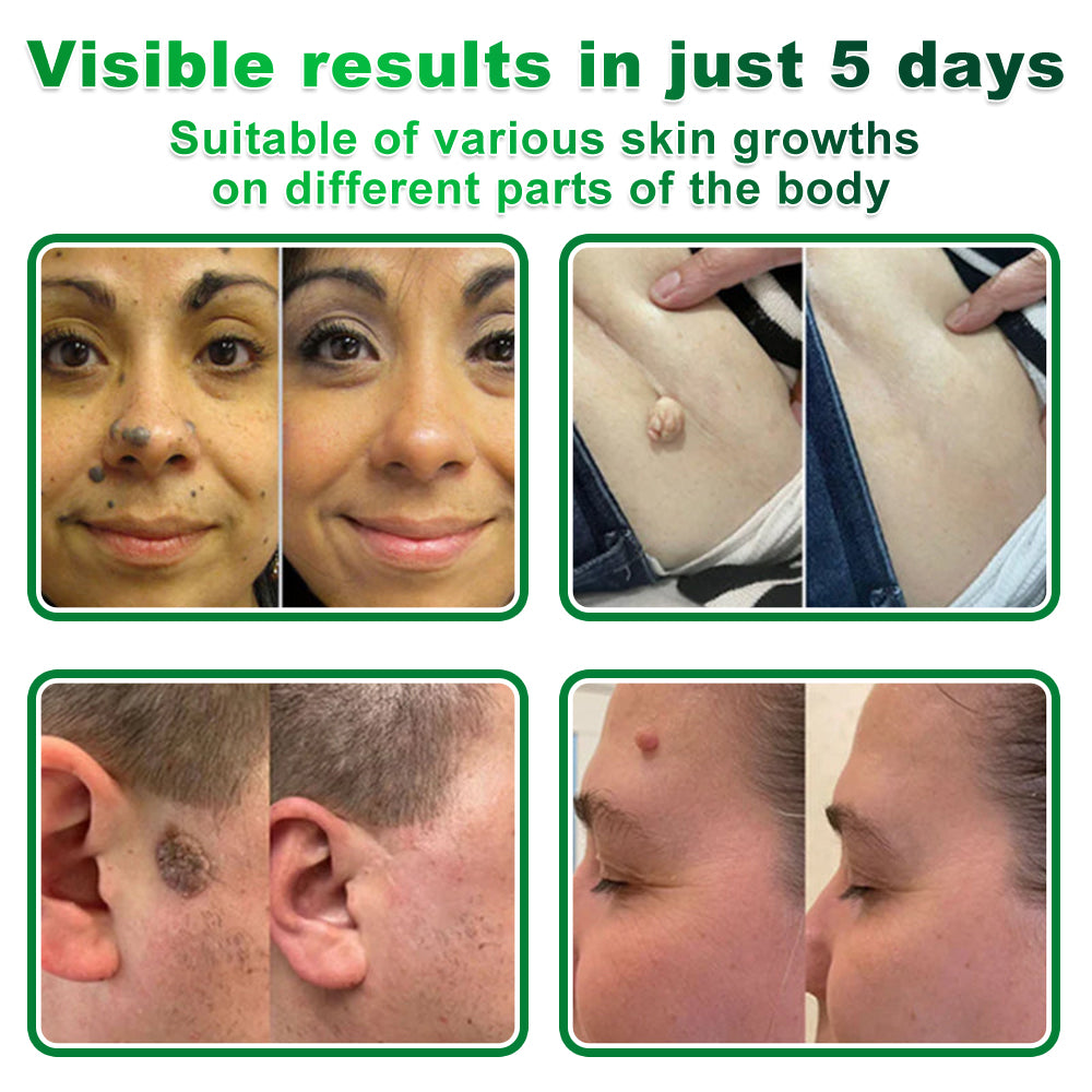 PolarFresh® Nano Microneedle Herbal Skin Tag Patch
