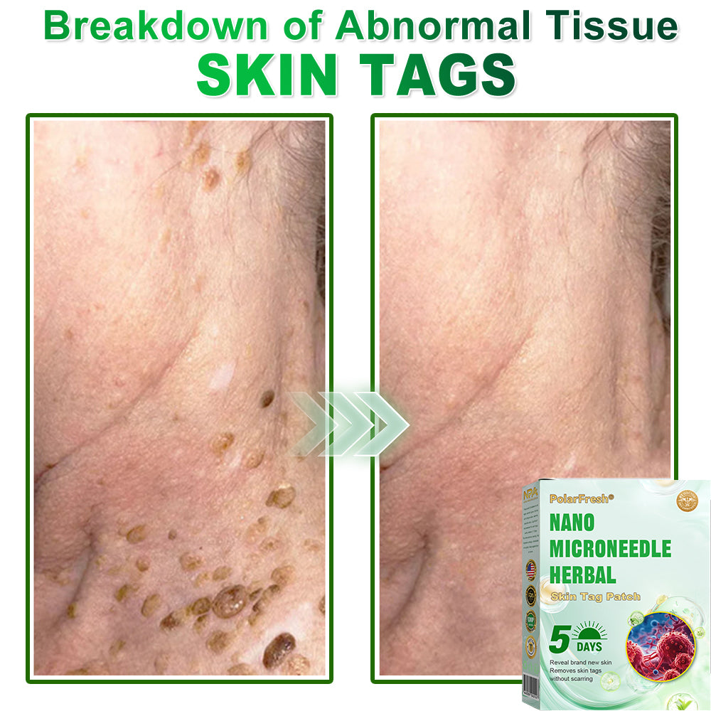 PolarFresh® Nano Microneedle Herbal Skin Tag Patch