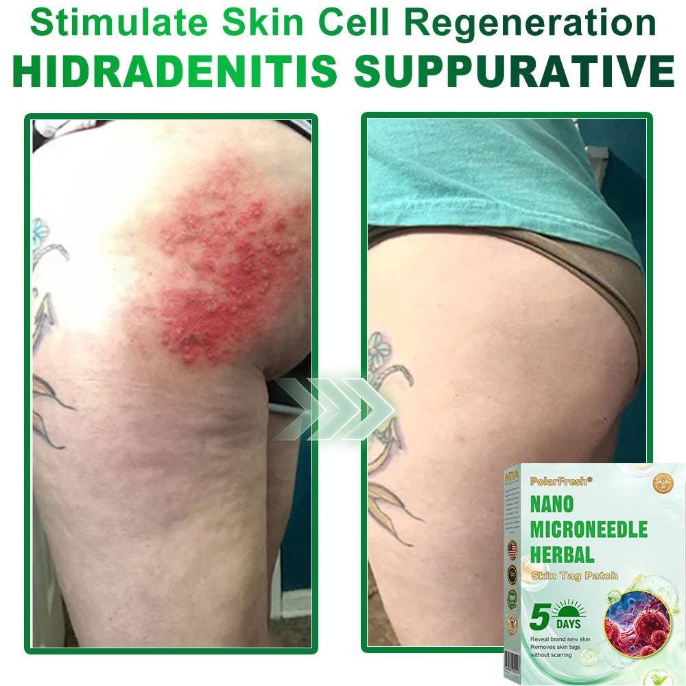 PolarFresh® Nano Microneedle Herbal Skin Tag Patch
