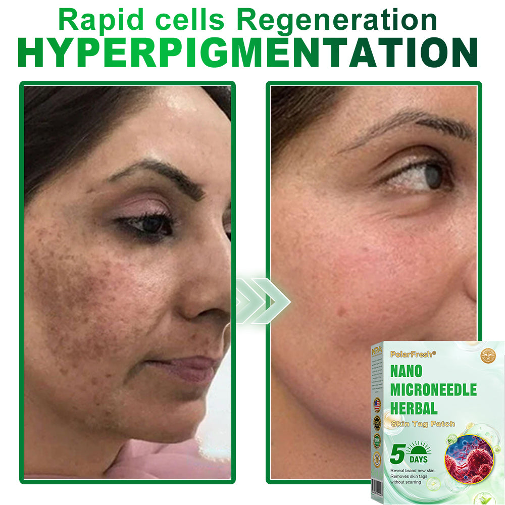 PolarFresh® Nano Microneedle Herbal Skin Tag Patch