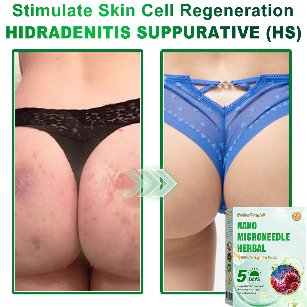PolarFresh® Nano Microneedle Herbal Skin Tag Patch