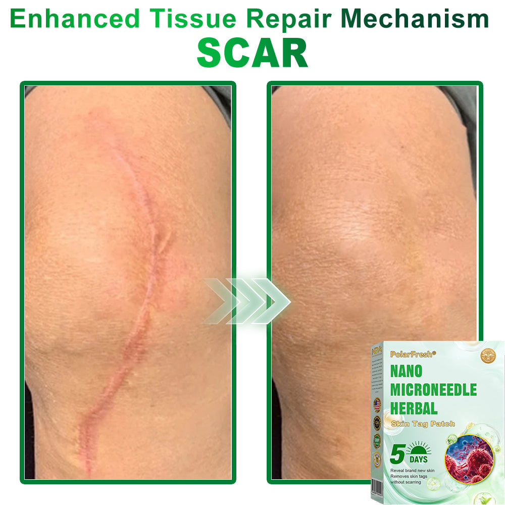 PolarFresh® Nano Microneedle Herbal Skin Tag Patch