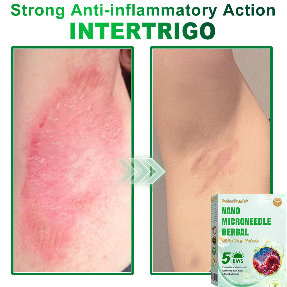 PolarFresh® Nano Microneedle Herbal Skin Tag Patch