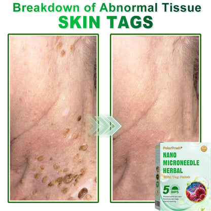 PolarFresh® Nano Microneedle Herbal Skin Tag Patch