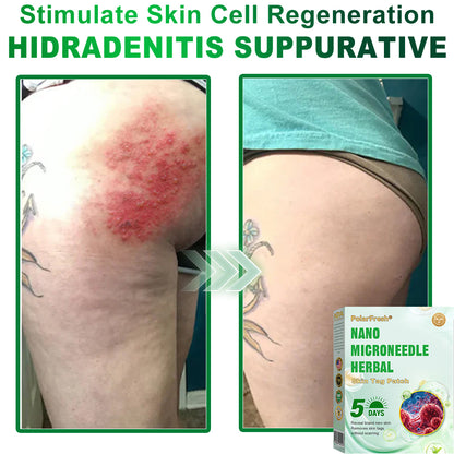 PolarFresh® Nano Microneedle Herbal Skin Tag Patch