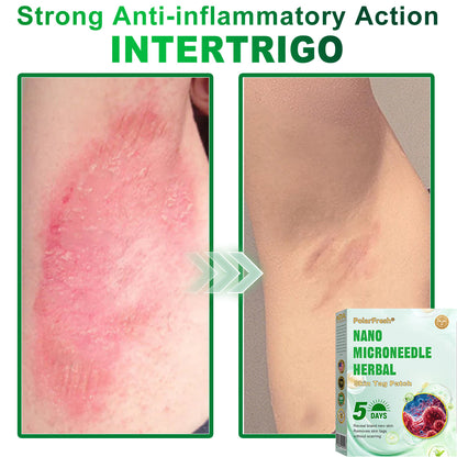 PolarFresh® Nano Microneedle Herbal Skin Tag Patch